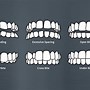 Image result for Ceramic Fixed Braces