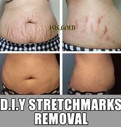 Image result for Heavy Stretch Marks Hangers