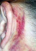 Image result for Postauricular Ecchymosis