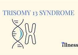 Image result for Chromosome 13 Syndrome