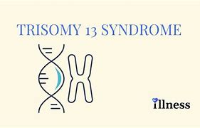 Image result for Trisomy Disorders