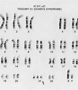 Image result for Down Syndrome Chromosomes