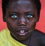 Image result for Waardenburg Syndrome Beautiful