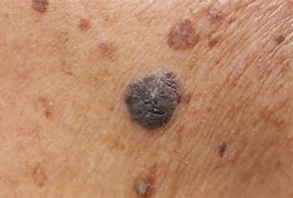 Image result for Untreated Stage 4 Melanoma