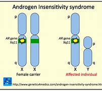 Image result for Androgen Insensitivity Syndrome