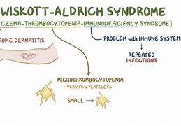Image result for Wiskott-Aldrich Syndrome