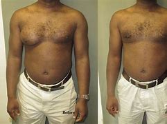 Image result for Severe Gynecomastia Male in Clothing