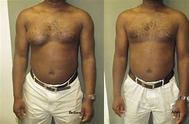 Image result for Worst Case of Gynecomastia