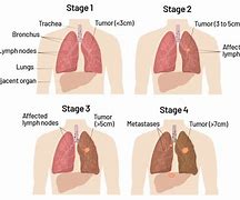 Image result for Lung Cancer Stages 1-4