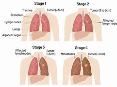 Image result for Lung Cancer Staging Stage 4