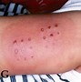 Image result for Kawasaki Disease Signs and Symptoms