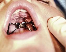 Image result for Expander Orthodontic Appliance