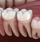 Image result for Impacted Wisdom Teeth