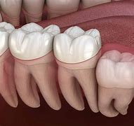 Image result for Wisdom Tooth Impaction