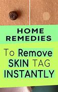 Image result for How to Remove Skin Tag On Anis