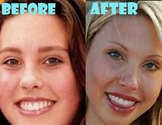 Image result for Chloe Lattanzi Before and After