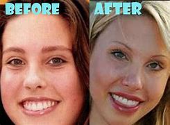 Image result for Chloe Lattanzi Before Plastic Surgery