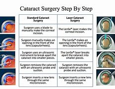 Image result for Cataract Surgery Procedure
