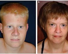 Image result for Prader-Willi Syndrome Mouth