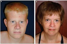Image result for Prader-Willi Syndrome Symptoms