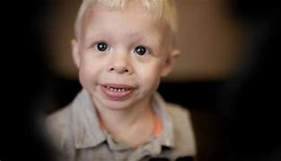 Image result for Williams Syndrome Life Expectancy