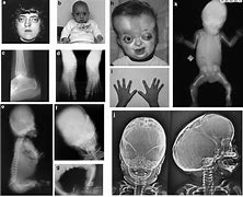 Image result for Pfeiffer Syndrome Genes