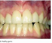 Image result for Periodontal Disease Problem