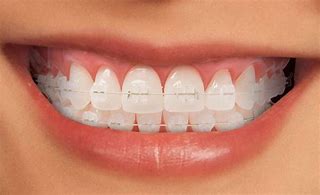 Image result for Ceramic Bracket with Color Band