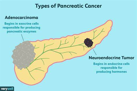 Pancreatic Cancer: Coping, Support, and Living Well