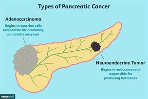 Image result for Pancreatic Cancer Types