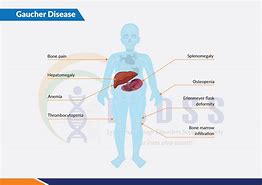 Image result for Gaucher Disease On a Human