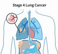 Image result for Stage 4 Terminal Cancer