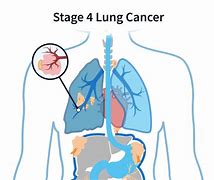 Image result for Stage 4 Lung Cancer Survival Rate