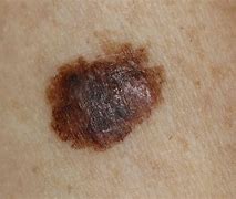Image result for Skin Cancer