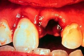 Image result for Tooth Damaged From Ultrasonics