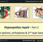 Image result for Hypospadias Fistula
