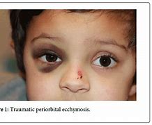 Image result for Periorbital Ecchymosis