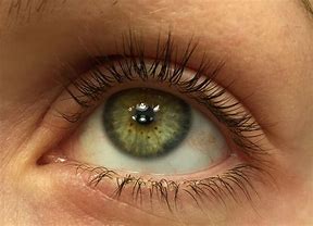 Image result for Eye Freckle