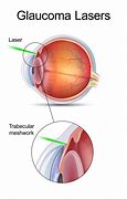 Image result for Glaucoma Surgery Procedure