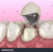 Image result for Dented Shield