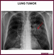 Image result for Chest X-Ray Lung Cancer Stage 4