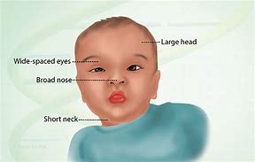 Image result for Noonan Syndrome Symptoms