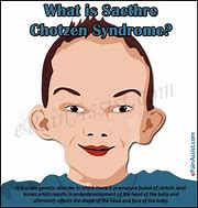 Image result for Saethre-Chotzen Syndrome
