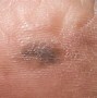 Image result for Skin Cancer Dark Spots