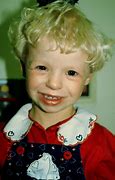 Image result for Williams Syndrome
