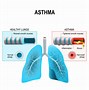 Image result for Allergic Asthma