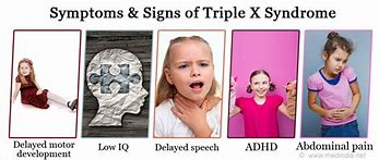 Image result for Triple X Turner Syndrome