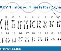 Image result for Trisomy XXY