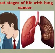 Image result for Stage 4 Non Small Lung Cancer