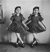 Image result for Josef Mengele Conjoined Twins